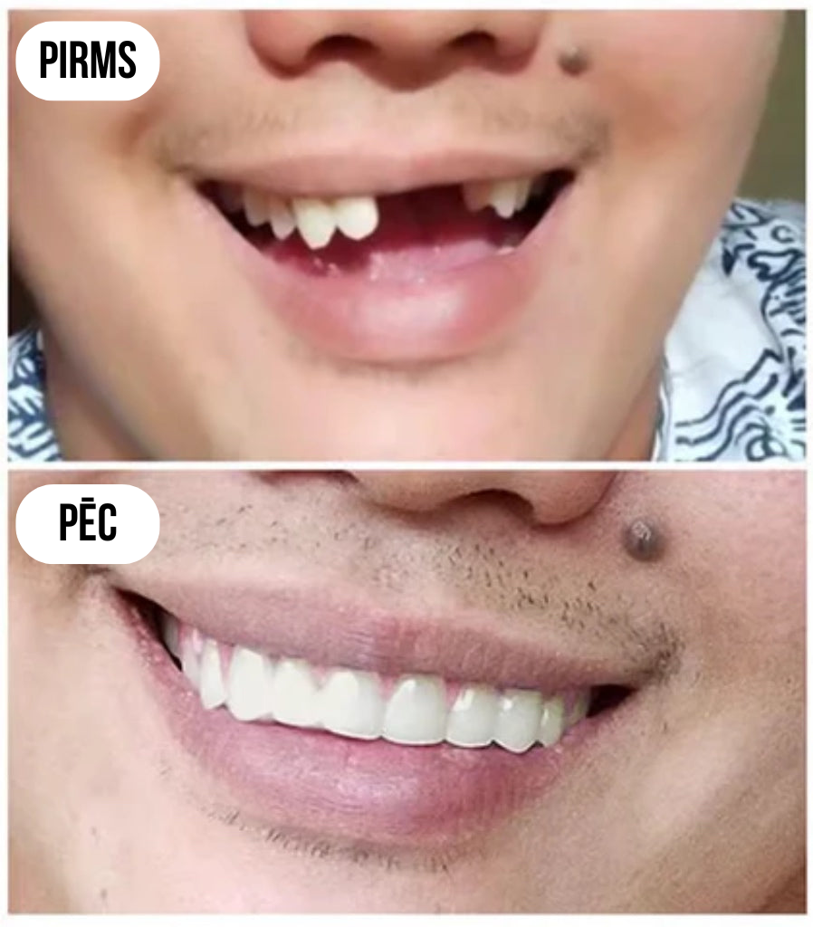 Zobu protēzes
